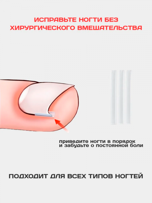 Корректор от вросших ногтей на ногах для педикюра