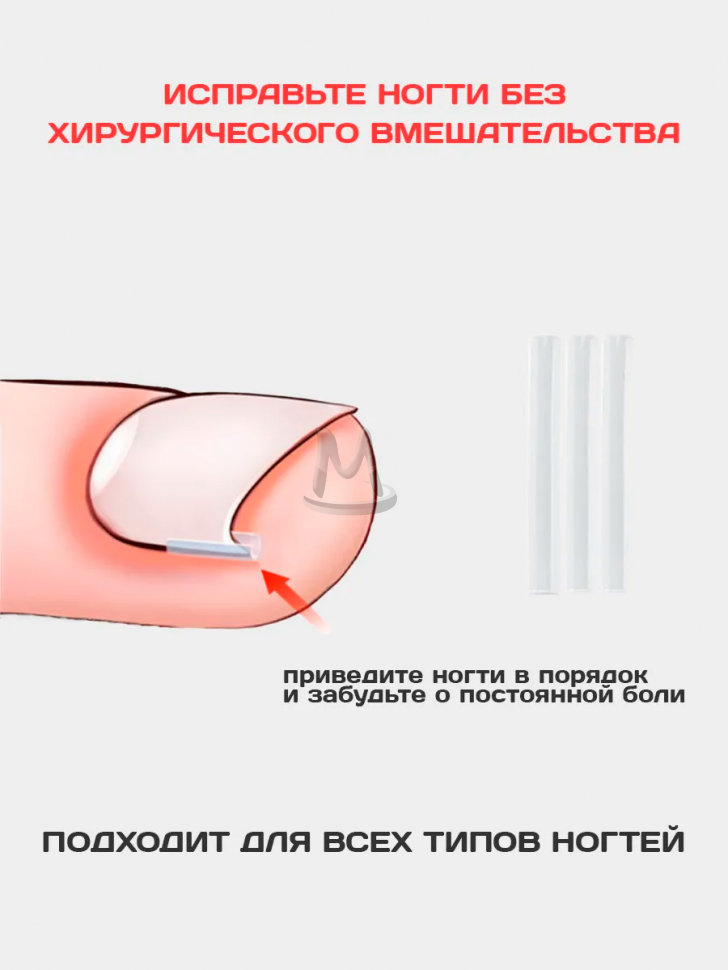 Корректор от вросших ногтей на ногах для педикюра